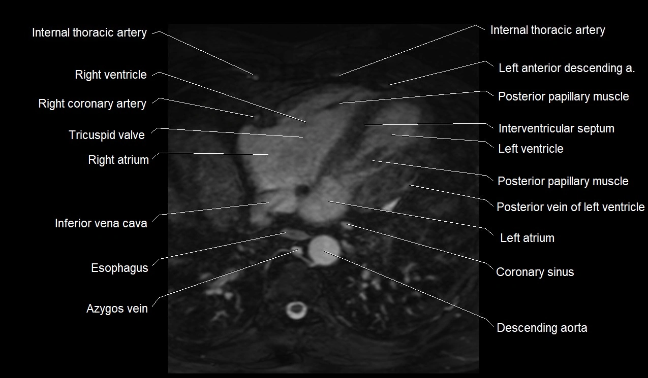 MRI heart coronary arteries and coronary veins anatomy axial image 33.webp